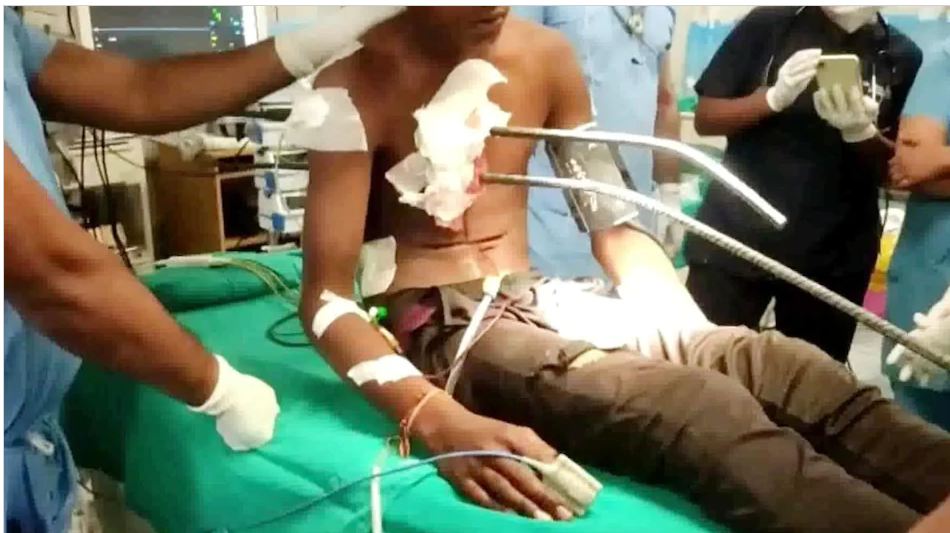 अद्भुत! युवक के सीने से आर पार हो गए 40 फीट लंबे लोहे के दो सर‍िया, ऑपरेशन कर रहे डॉक्टरों ने कर दिया कमाल