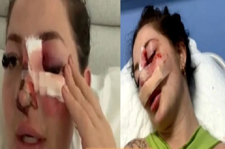 फ्लर्ट कर रहा था बॉक्सर.. महिला के ‘ना’ कहने पर मुक्का मारकर तोड़ दी नाक