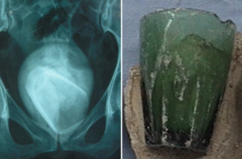 डॉक्टरों ने सर्जरी कर ​महिला के प्राइवेट पार्ट से निकाला कांच का गिलास, बताया 4 साल पहले कैसे वहां तक पहुंचा था गिलास