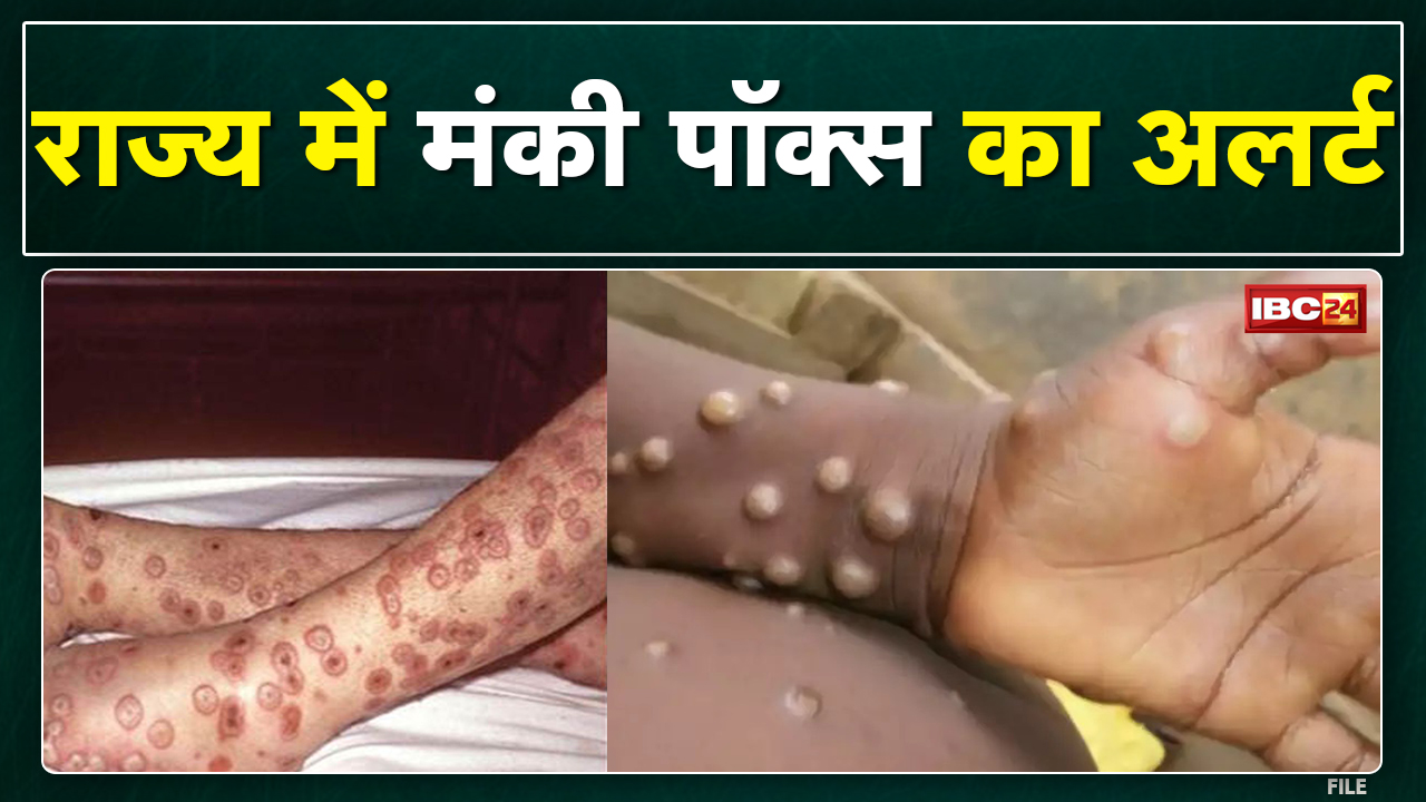 Monkeypox Virus Alert : भारत के इस राज्य में जारी हुआ अलर्ट | सभी जिलों में निगरानी करने के निर्देश.