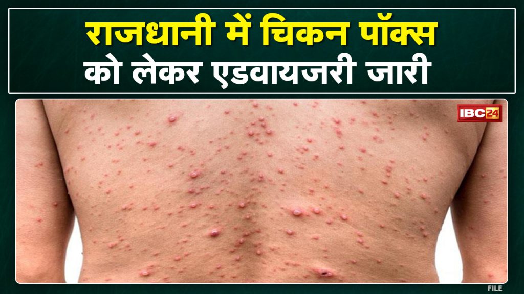 Advisory issued for Chicken Pox in Bhopal. Children and pregnant women are at greater risk