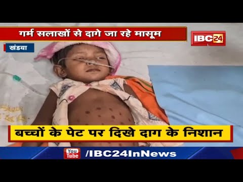 Khandwa News : अंधविश्वास का फायदा उठा रहे तांत्रिक | गर्म सलाखों से दागे जा रहे मासूम…
