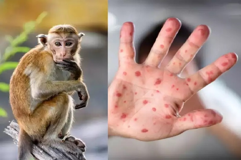 monkey pox Alert in india