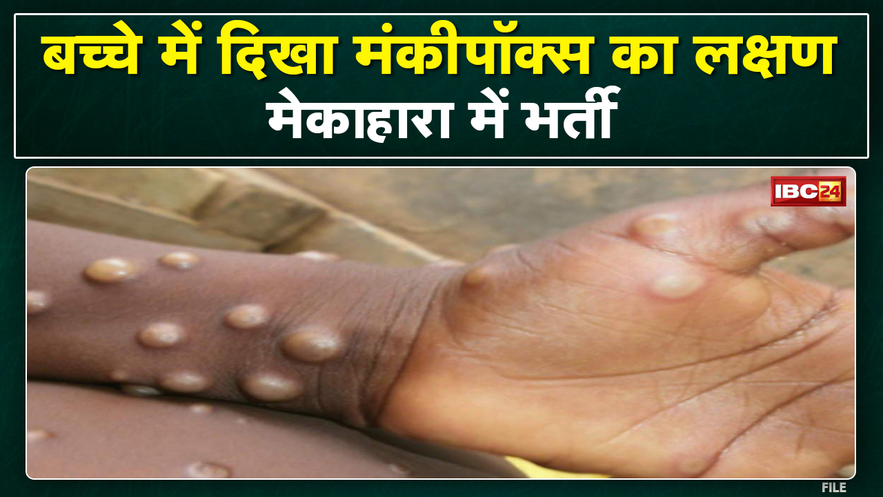 Monkey Pox Virus in Chhattisgarh : रायपुर में दिखा बच्चे में मंकीपॉक्स का लक्षण | मेकाहारा में भर्ती