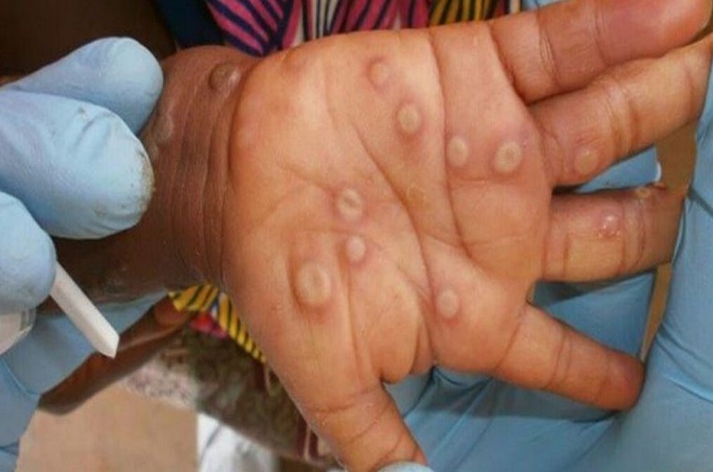 The entry of monkey pox