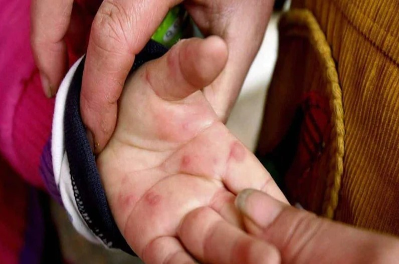 Tomato Flu ! तेजी से फैल रही यह बीमारी, शरीर के यह अंग आ सकते  हैं चपेट में, जानें क्या  हैं लक्षण?