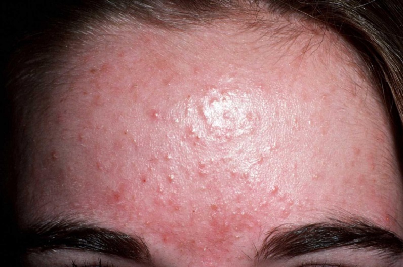 Forehead Rash