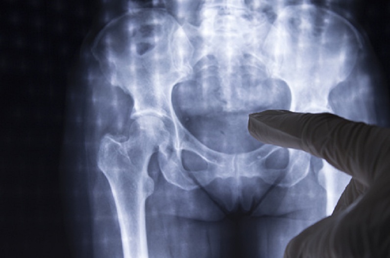 Vegetarian women are at risk of Hip Fracture