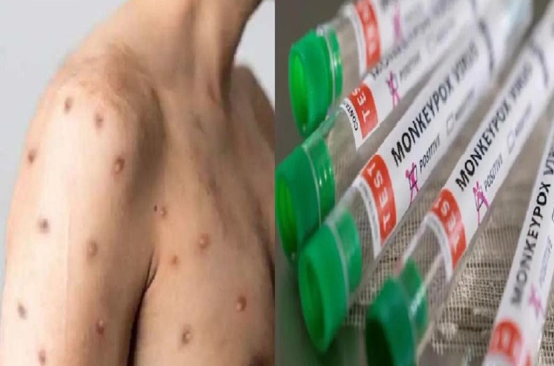 Health department issued high alert regarding monkeypox in the state