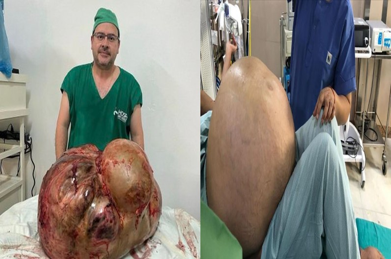 महिला के पेट से निकला इतना बड़ा ट्यूमर, देखकर डॉक्टर्स हुए हैरान, जानें कितना है वजन…