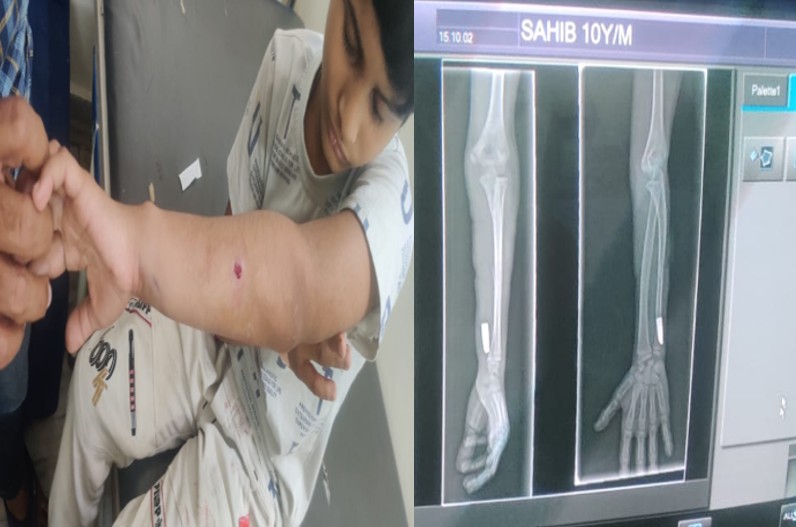 10 Year Old by Shot by Air fire : हवाई फायर में 10 साल के बच्चे को लगी गोली, अस्पताल में कराया गया भर्ती, घर के बाहर खेल रहा था मासूम