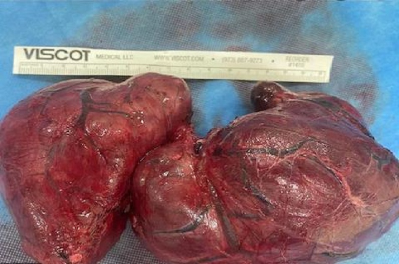 मरीज के इस अंग में फंसा था नारियल जितना बड़ा ट्यूमर, 3 घंटे चला ऑपरेशन, फिर जो हुआ…