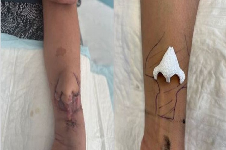 कभी नहीं देखा होगा विज्ञान का ऐसा चमत्कार! महिला के हाथ में ही उगा दी नई नाक, फिर….