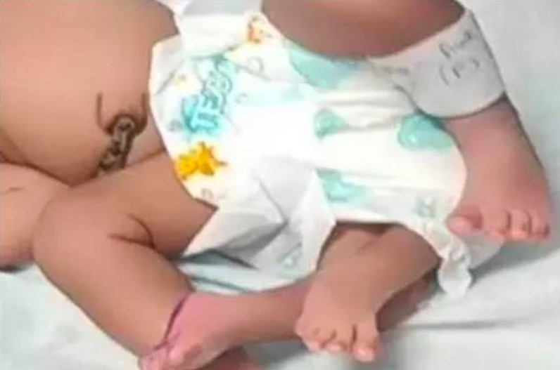 Woman gave birth to a 4 legged baby girl