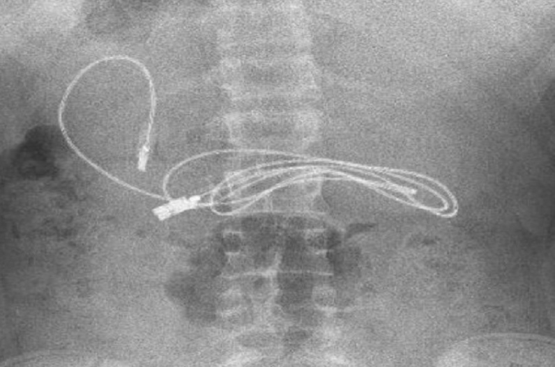 फटी रह गई डॉक्टर की आंखे, जब बच्चे के पेट से निकला ये सामान, परिजन भी हो गए हैरान