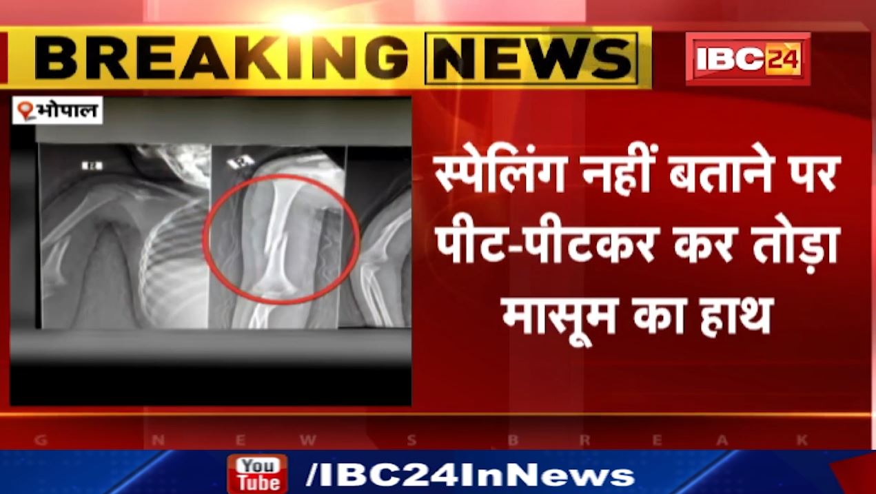 ट्यूशन टीचर ने तोड़ दिया 5 साल की मासूम का हाथ। स्पेलिंग नहीं बताने पर की बच्ची की बेरहमी से पिटाई