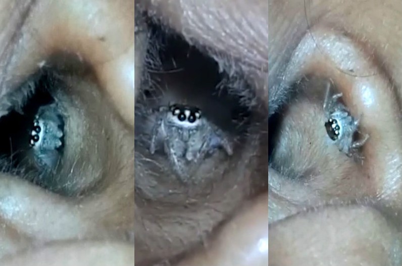 महिला के कान में मकड़ी ने बनाया घर, ऑपरेशन थिएटर से सामने आया डराने वाला वीडियो ..देखें