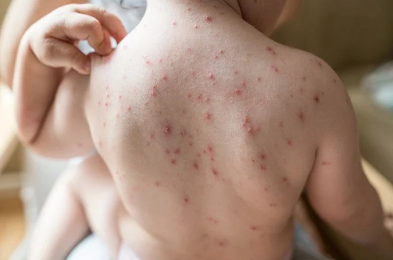 What are the 3 stages of chickenpox?