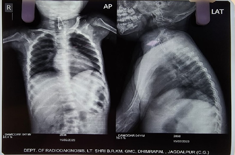 Jagdalpur news: 4 साल के मासूम ने निगली ये नुकीली चीज, सर्जरी के दौरान फटी रह गई डॉक्टरों की भी आंखें