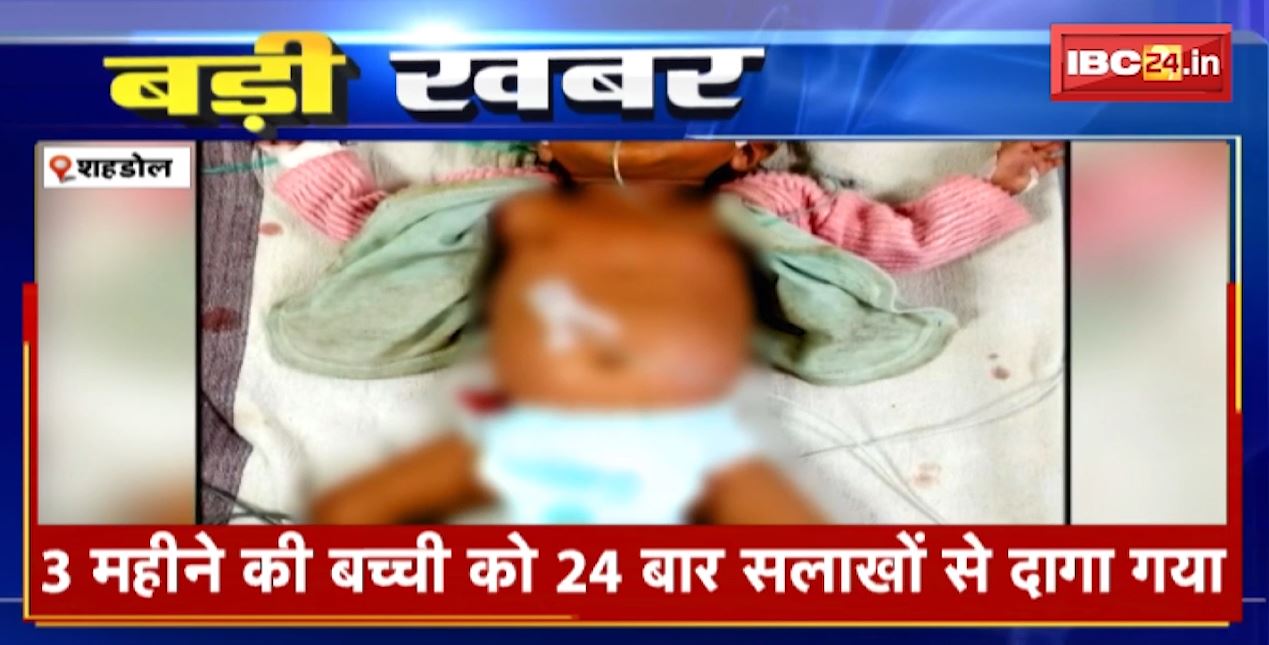 3 महीने की बच्ची को 24 बार सलाखों से दागा। बच्ची को सांस लेने में हो रही थी दिक्कत