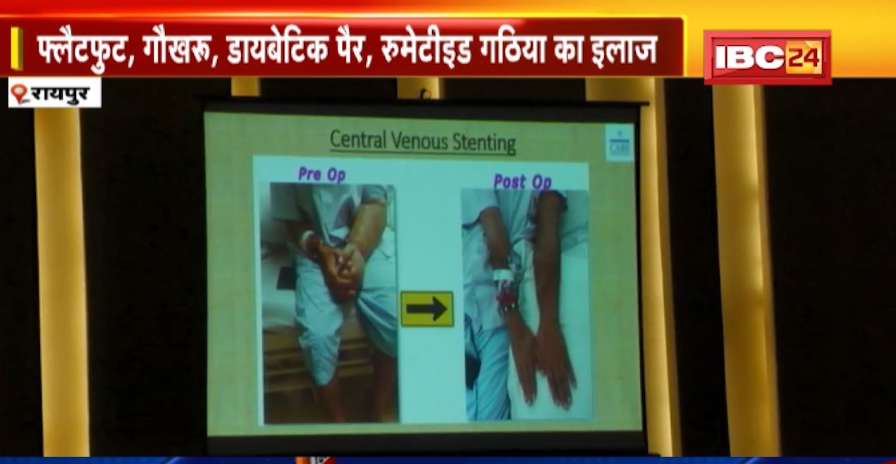 अब हड्डी रोग के लिए स्पेशल सुविधा। रामकृष्ण केयर हॉस्पिटल की नई पहल। रायपुर में ‘मुंबई नी’, फुट, एंकल क्लीनिक की शुरुआत
