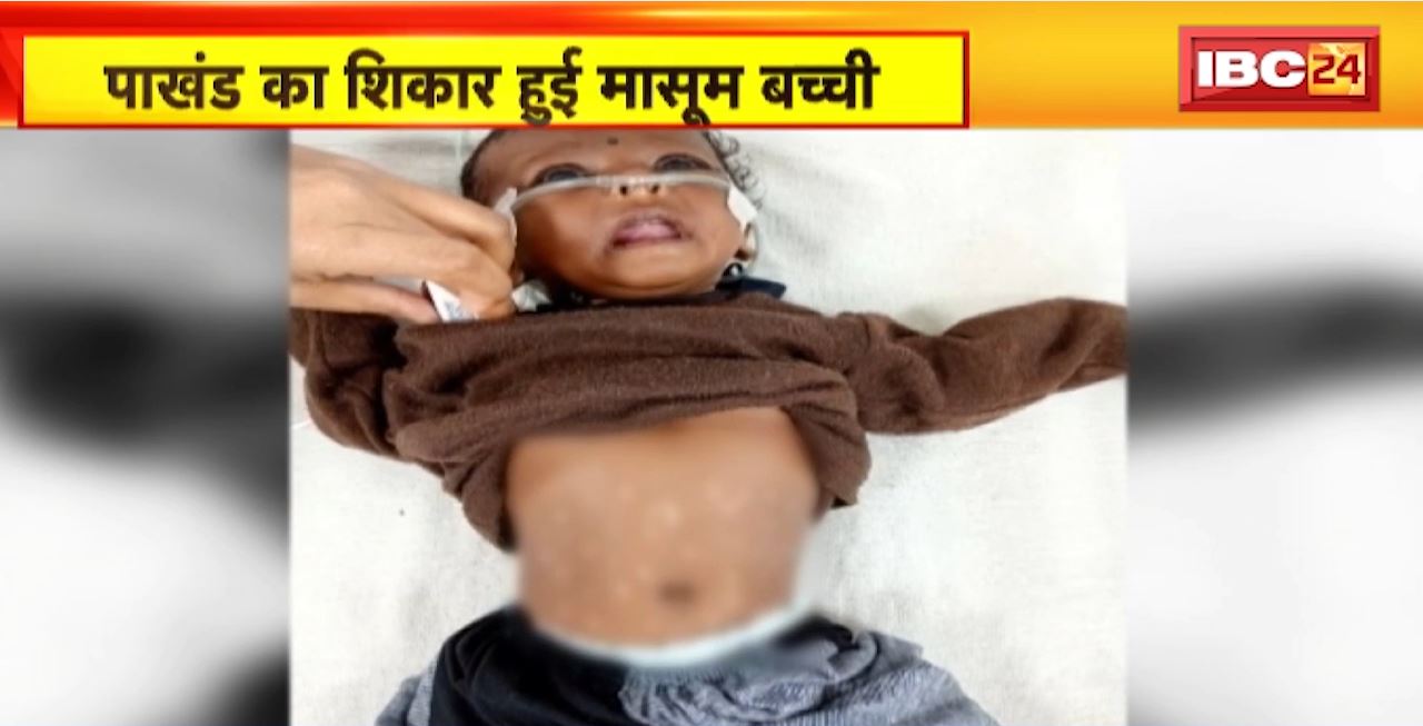 Shahdol News : पाखंड का शिकार हुई मासूम बच्ची। 24 बार गर्म सलाखों से दागा गया मासूम बच्ची को