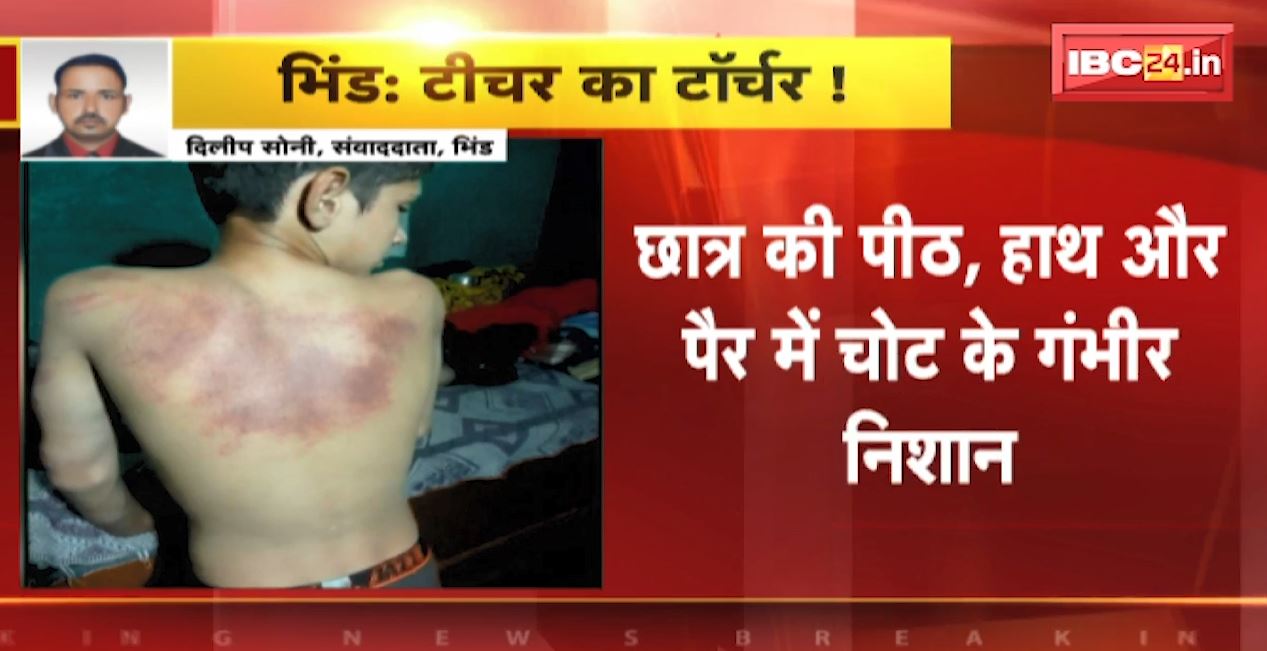 2 छात्रों के बीच विवाद होने पर शिक्षक ने की छात्र की पिटाई। शिक्षक ने बेल्ट से की छात्र की बेरहमी से पिटाई
