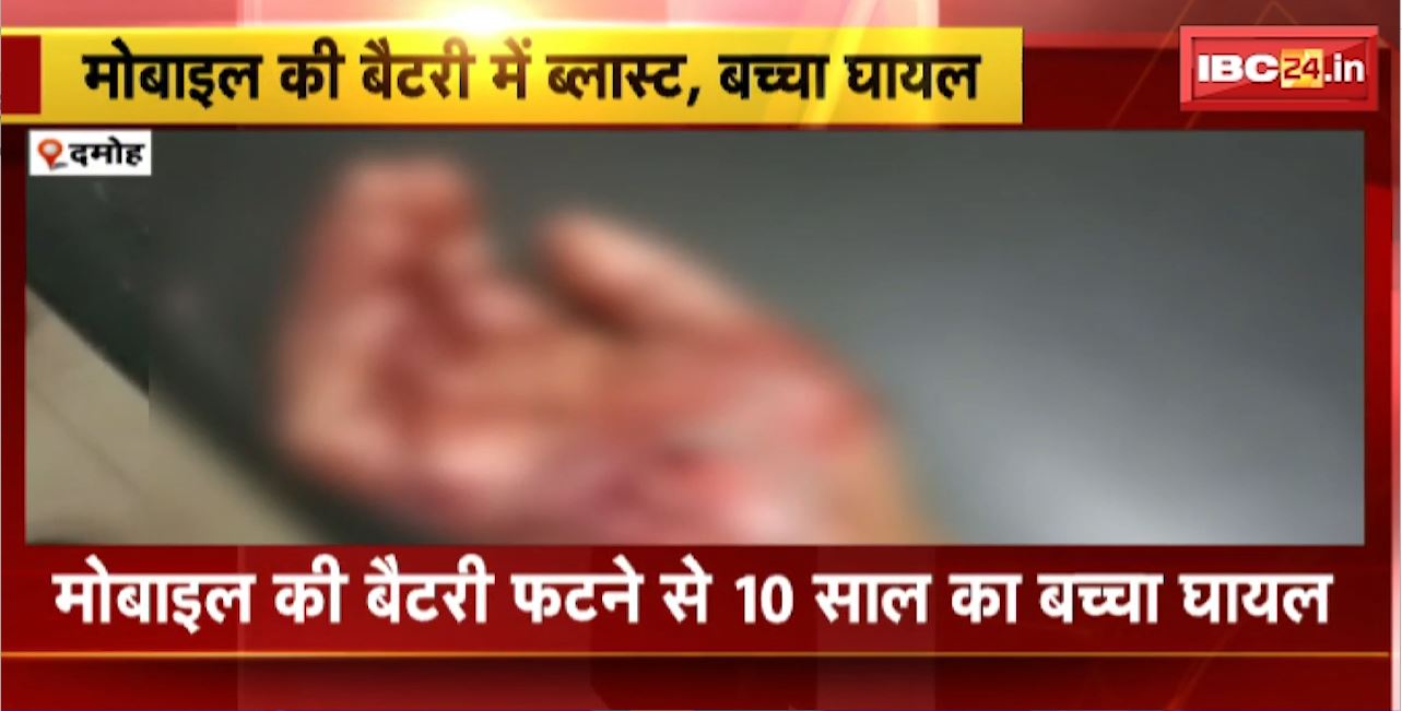 Damoh Mobile Blast : दमोह में मोबाइल की बैटरी फटने से 10 साल का बच्चा घायल। गंभीर हालत में जिला अस्पताल में भर्ती