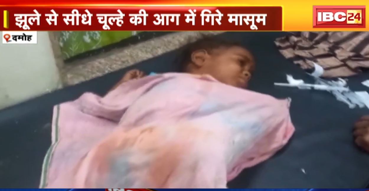 दमोह में आग में झुलसे दो मासूम। झूले से सीधे चूल्हे की आग में गिरे बच्चे। देखिए…