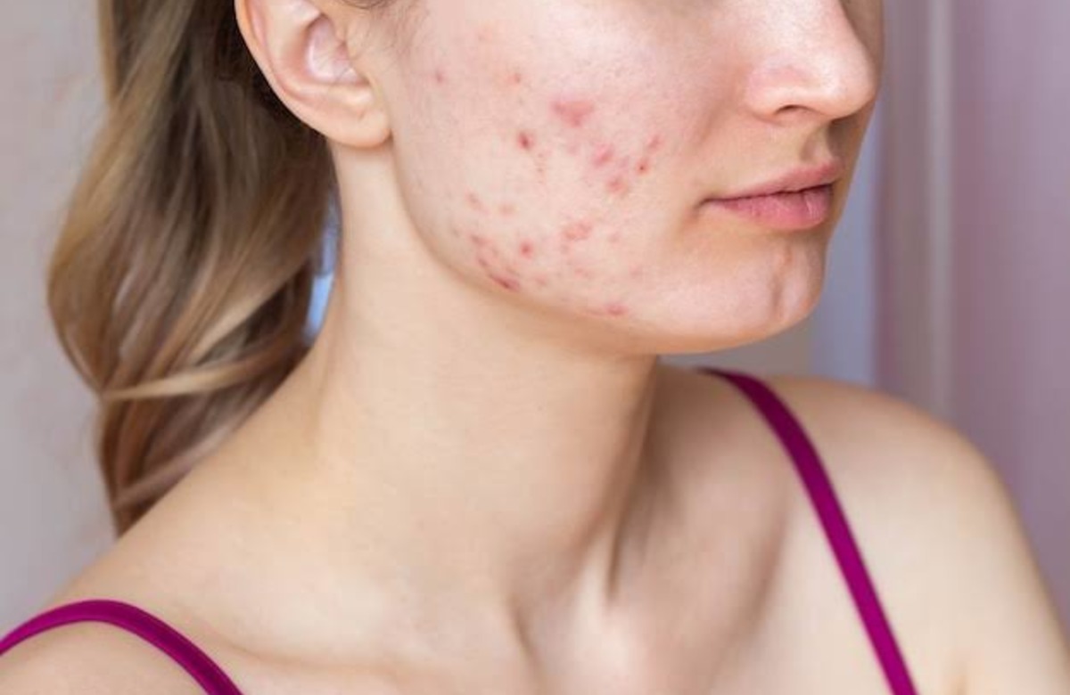 चेहरे से कील-मुहांसे हटाने के ये है सबसे आसान घरेलू उपाय, एक ही रात में दमकने लगेगा आपका चेहरा