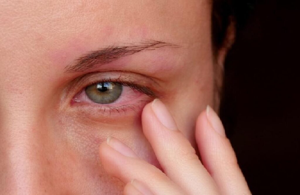 viral conjunctivitis