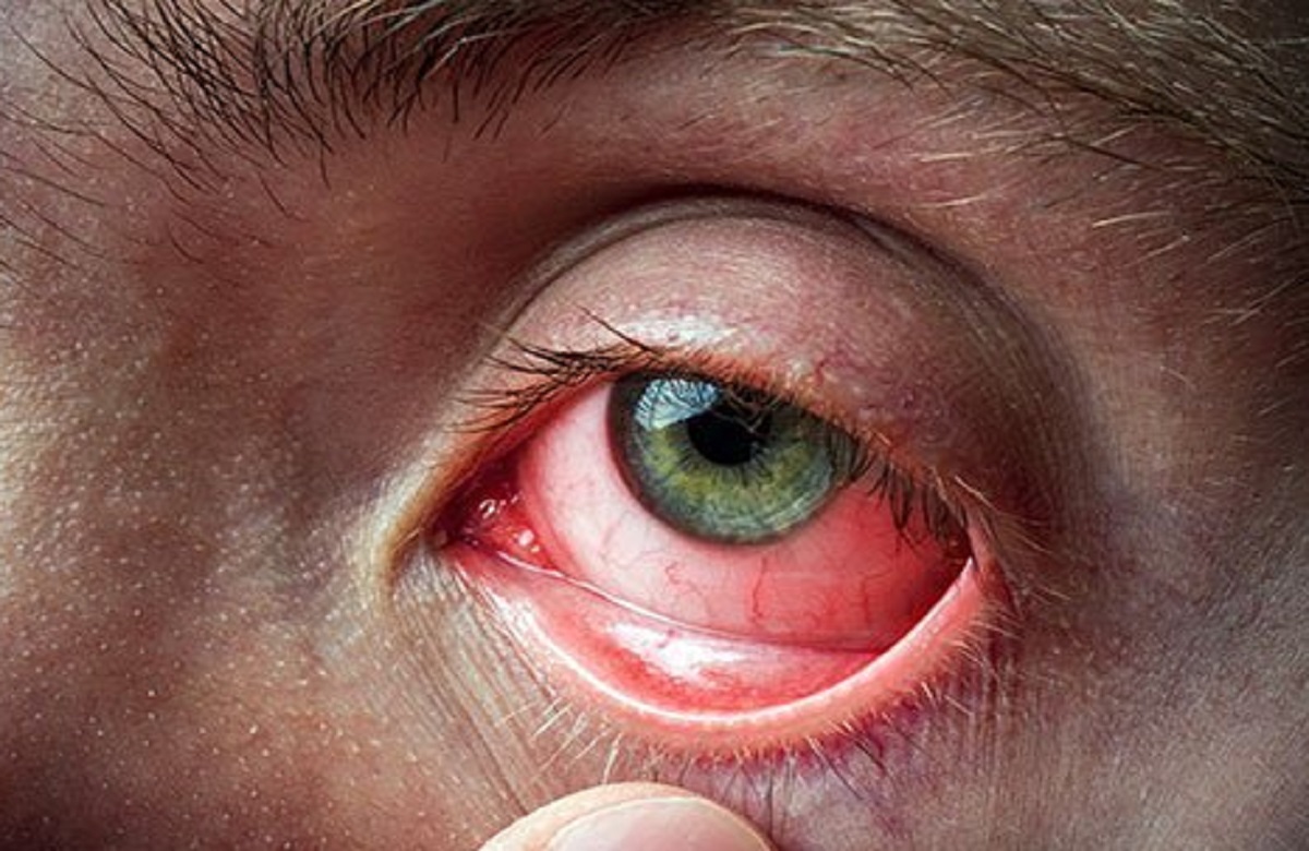 बरसात में आंखों का रखें विशेष ध्यान, नहीं तो हो सकती है एलर्जिक कंजंक्टिवाइटिस, जानिए क्या है इसके लक्षण…