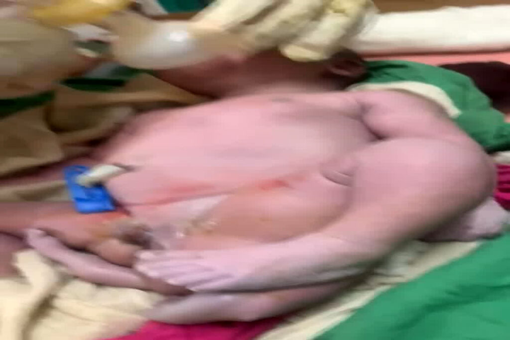 Woman gave birth to a four legged baby