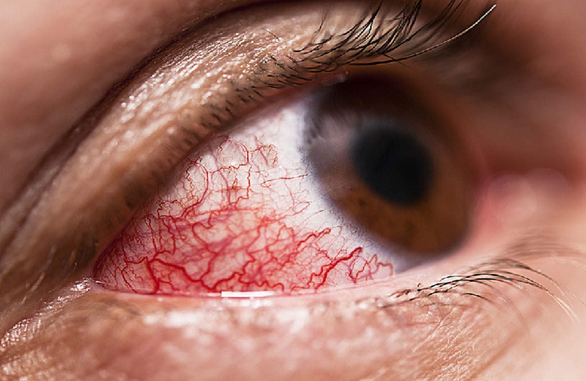 आंखों में दिखता है डायबिटीज का लक्षण, हाई ब्लड शुगर से हो सकती है परेशानी, नेत्र विशेषज्ञ ने बताई ये बात