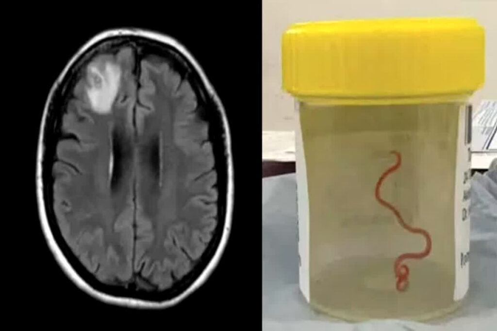 A live insect found crawling in the brain of a woman