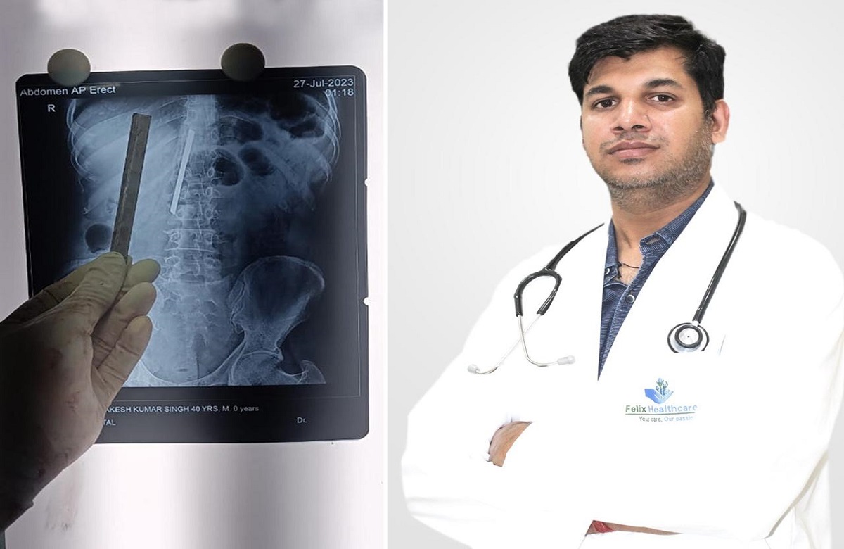 OMG..! शख्स के पेट से घुस गयी थी ऐसी चीज, बिल्कुल अनजान था मरीज, रिपोर्ट देख डॉक्टर्स के उड़ गए होश