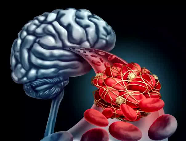 Brain Stroke Symptoms: क्या हमेशा सिर रहता है भारी? तो इस शुरुआती लक्षण को न करें नजर अंदाज, वरना फट सकती है दिमाग की नस