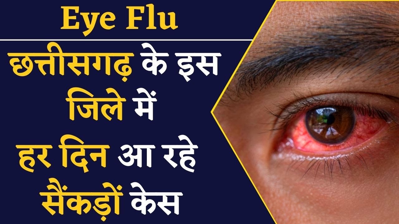 छत्तीसगढ़ में Eye Flu से बुरा हाल, इस जिले में एक दिन में आए सैंकड़ों केस | CG News | Khabar Bebak