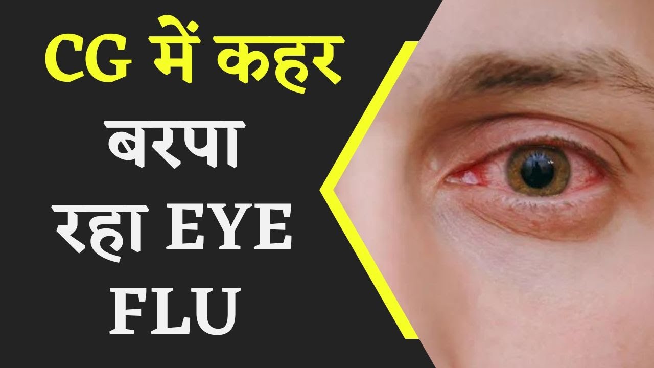 CG में कहर बरपा रहा EYE FLU, एक ही दिन में 500 से भी ज़्यादा मरीज़ मिले