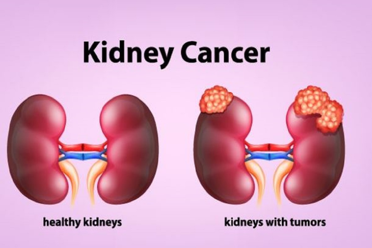 Kidney Cancer: पेशाब में जलन या बदला रंग हो सकता है किडनी का कैंसर, सावधानी के साथ करें ये उपाय