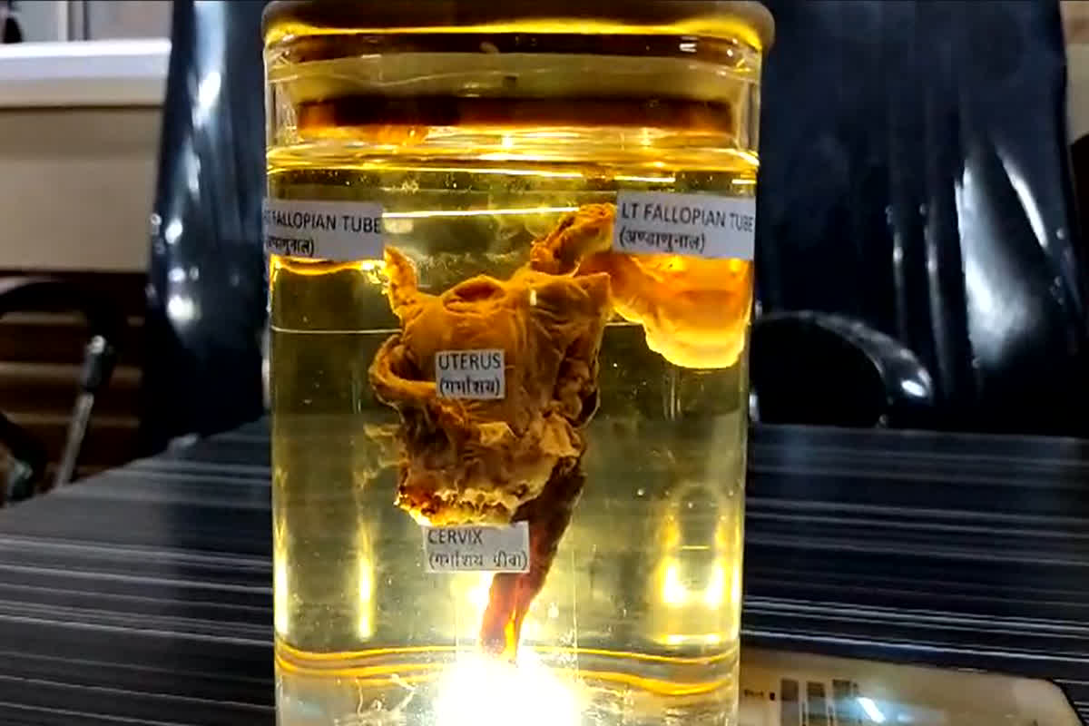 Uterus in man’s Stomach : युवक के पेट में गर्भाशय और नसबंदी की नली, ऑपरेशन के दौरान देखकर डॉक्टर भी हो गए हैरान