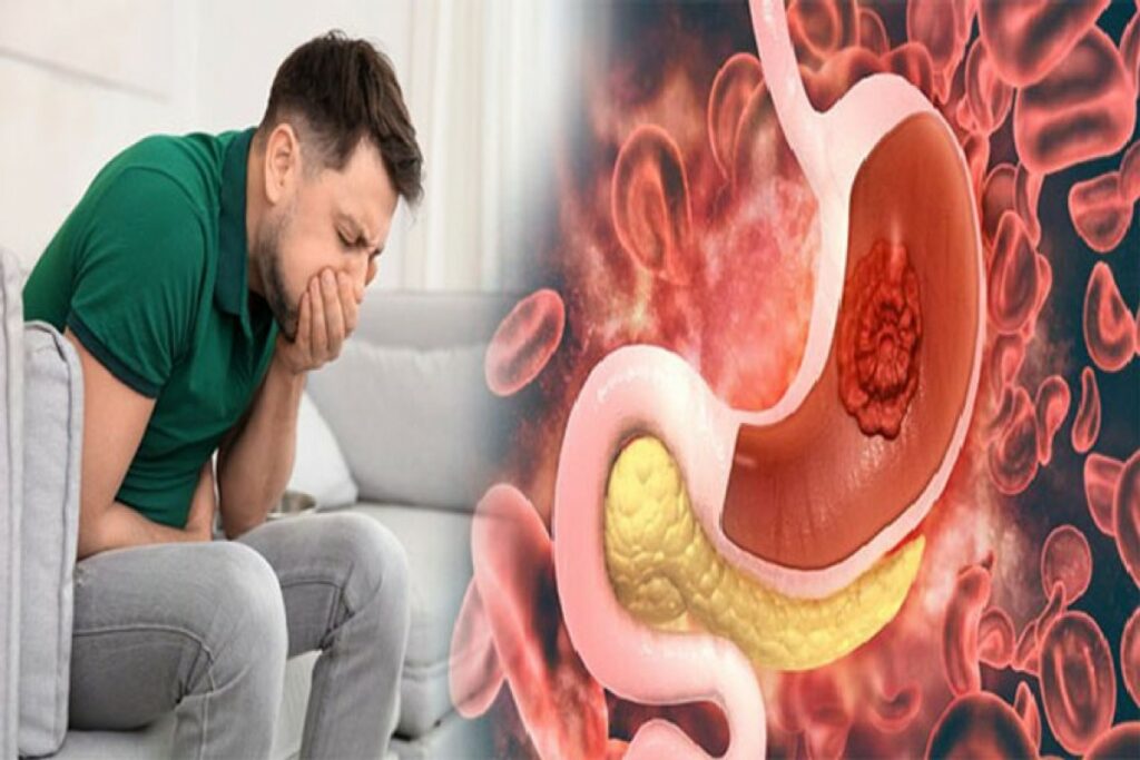 stomach cancer