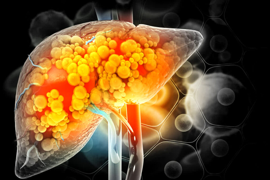 fatty liver disease symptom