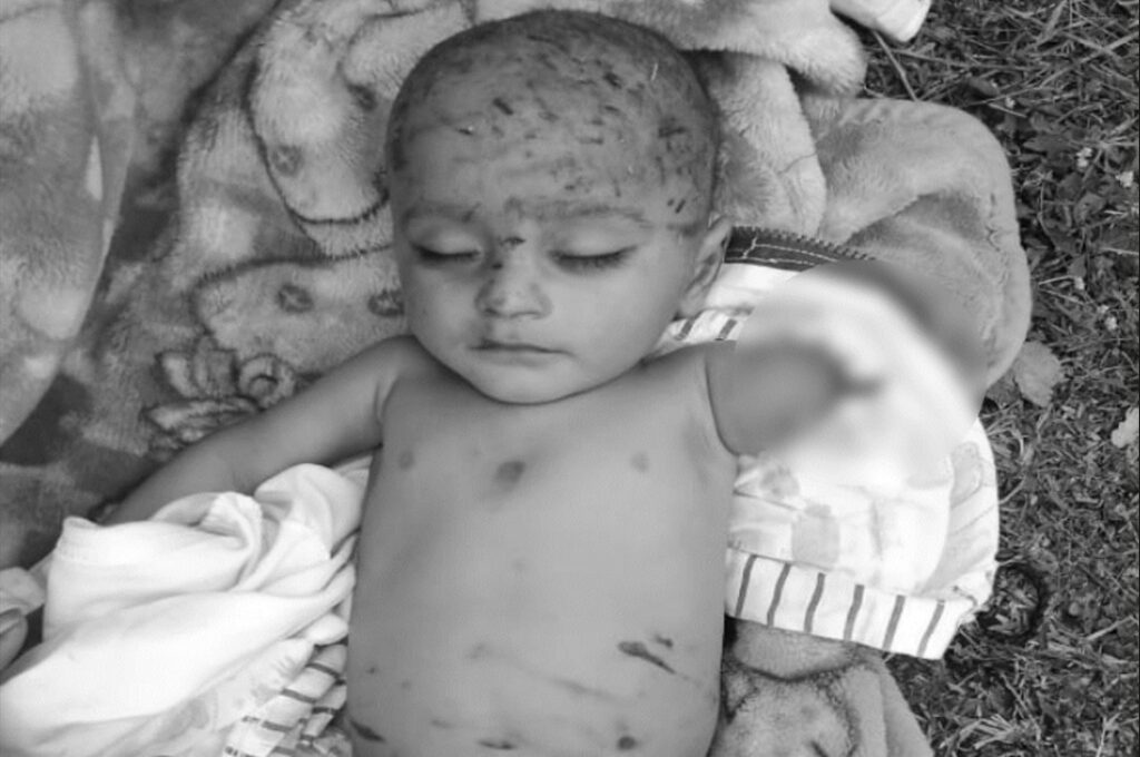 Child Dies Due to Stray Dog A​ttack