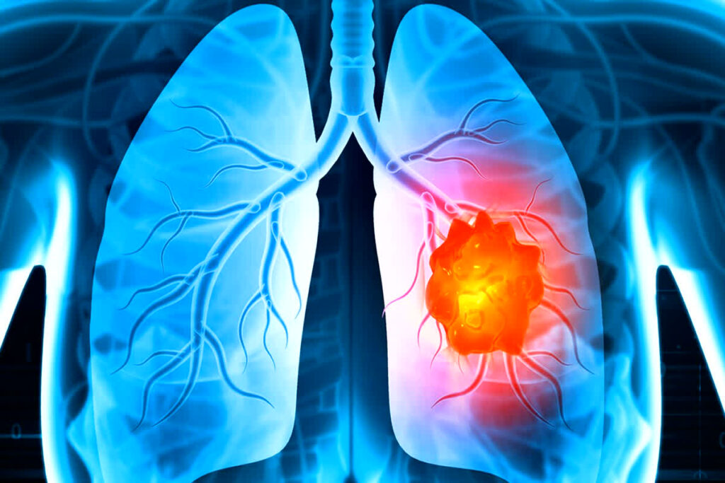 Symptoms of Lung Cancer