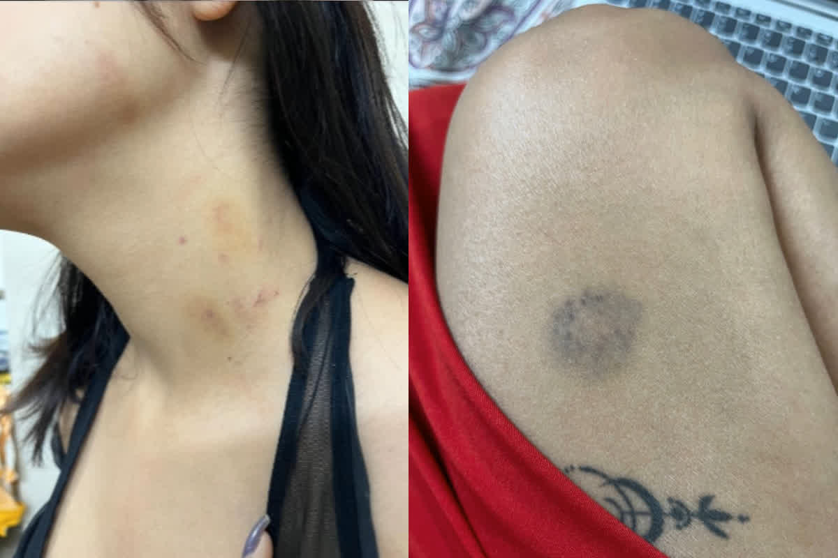 Beaten Live in Partner: लिव इन पार्टनर के साथ की मारपीट, जबर्दस्ती किया सेक्स, प्राइवेट पार्ट में डाल दिया मिर्ची पावडर