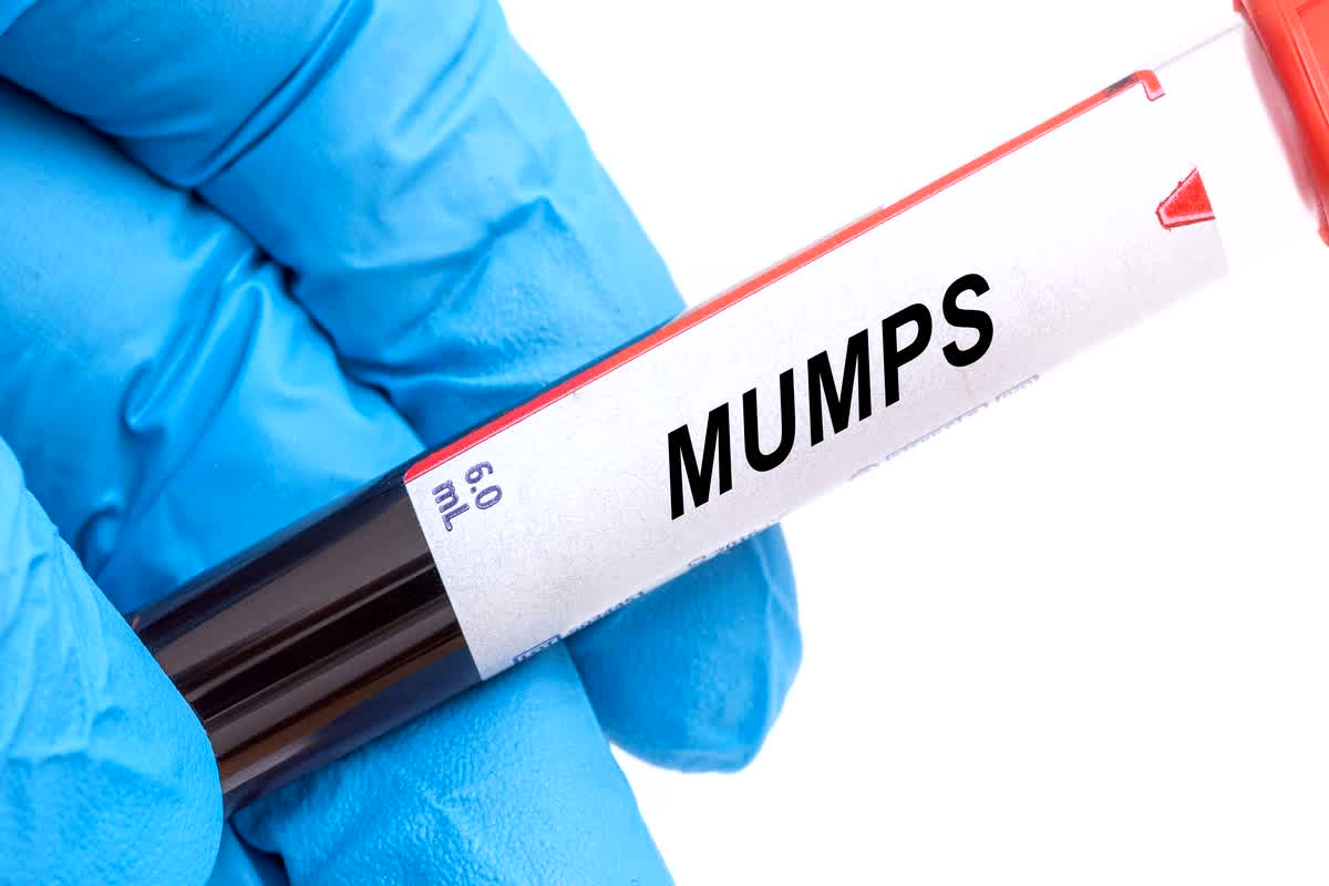 Mumps Virus: सावधान…! देश में तेजी से बढ़ रहा एक और खतरनाक वायरस, इन लक्षणों को भूलकर भी न करें नजरअंदाज