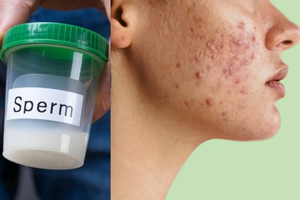 Does sperm remove pimples and acne from the face?