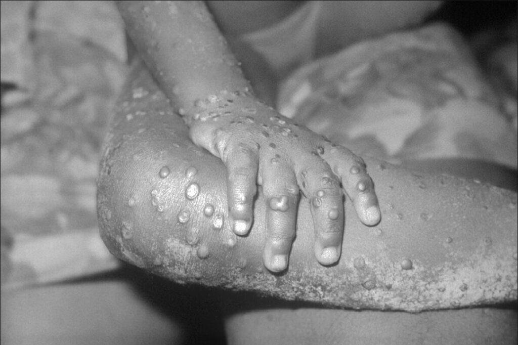 New guidelines to prevent monkeypox virus