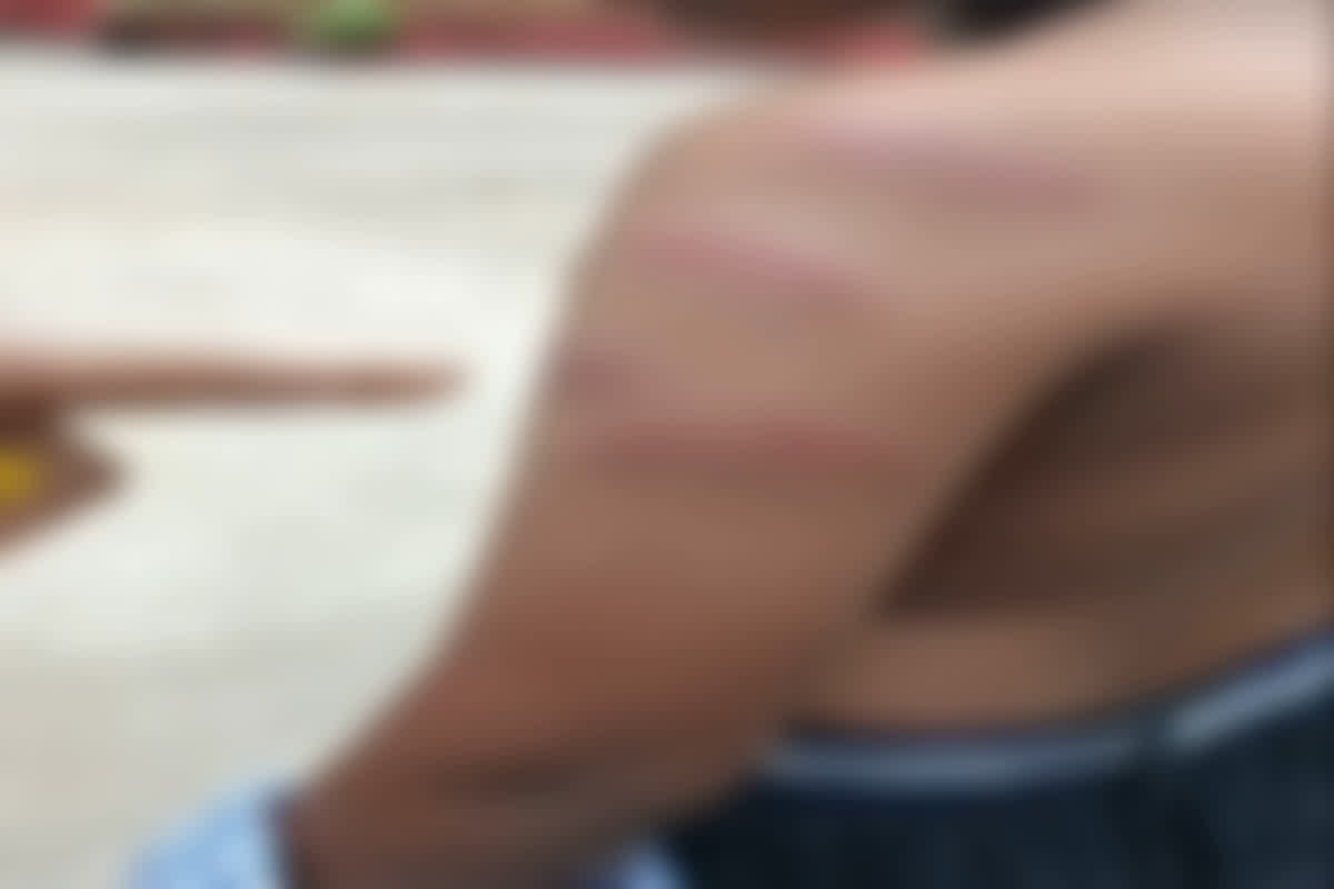 Bilaspur News: मामूली सी बात पर जल्लाद बना शिक्षक, छड़ी टूटने तक की छात्र की पिटाई, पीठ और बांह पर बने गहरे जख्म, जानें वजह